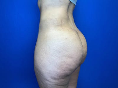Brazilian Butt Lift Before & After Gallery - Patient 149341997 - Image 8
