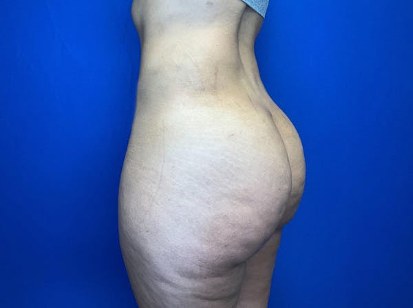 Brazilian Butt Lift Before & After Gallery - Patient 149341997 - Image 8