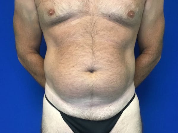 Liposuction Before & After Gallery - Patient 149342110 - Image 1