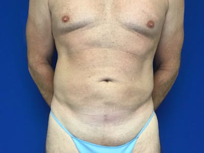 Liposuction Before & After Gallery - Patient 149342110 - Image 2
