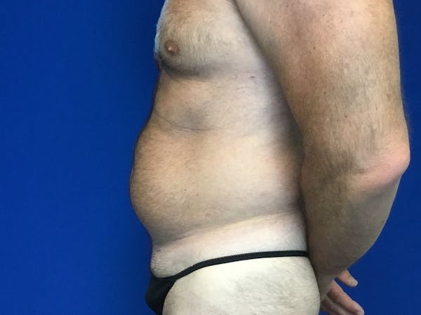 Liposuction Before & After Gallery - Patient 149342110 - Image 3