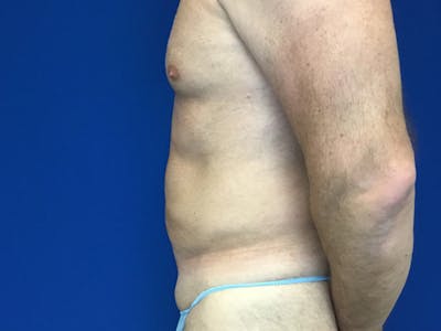 Liposuction Before & After Gallery - Patient 149342110 - Image 4