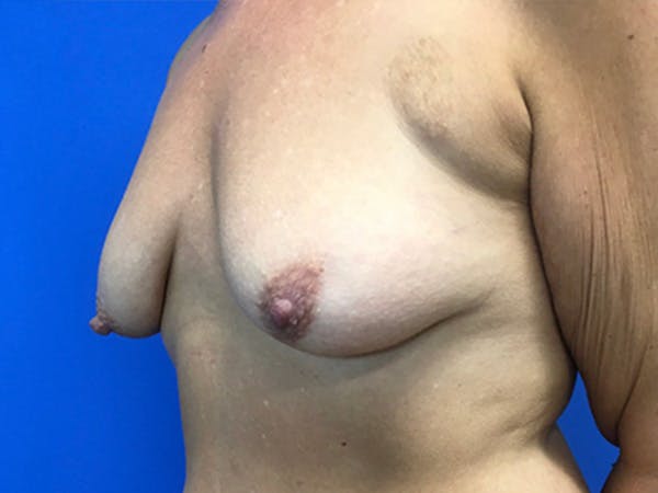 Breast Augmentation Before & After Gallery - Patient 149405757 - Image 3