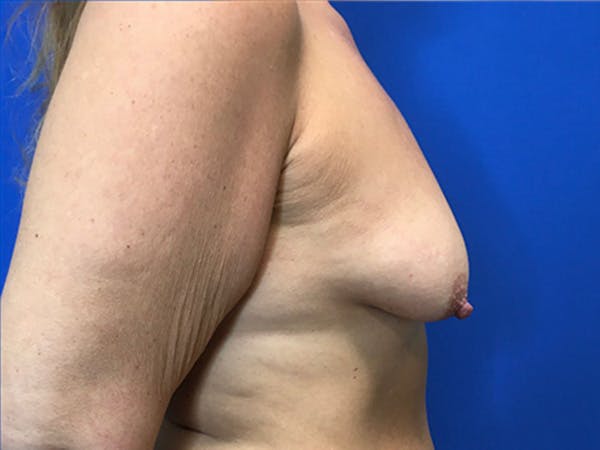 Breast Augmentation Before & After Gallery - Patient 149405757 - Image 5
