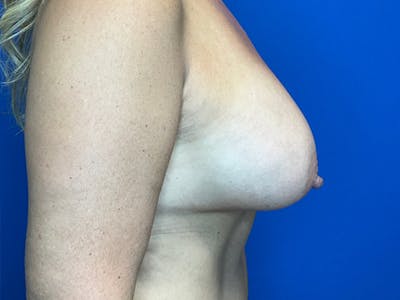 Breast Augmentation Before & After Gallery - Patient 149405757 - Image 6
