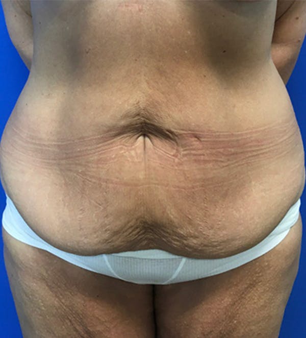 Tummy Tuck (Abdominoplasty) Before & After Gallery - Patient 149405760 - Image 1