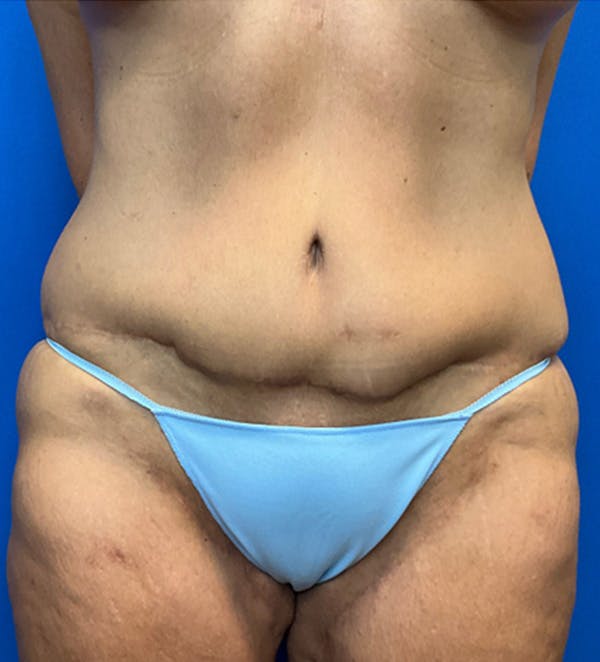 Tummy Tuck (Abdominoplasty) Before & After Gallery - Patient 149405760 - Image 2