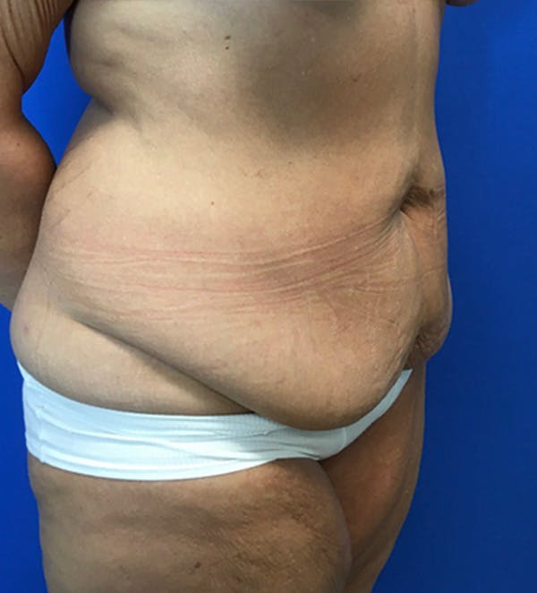 Tummy Tuck (Abdominoplasty) Before & After Gallery - Patient 149405760 - Image 3