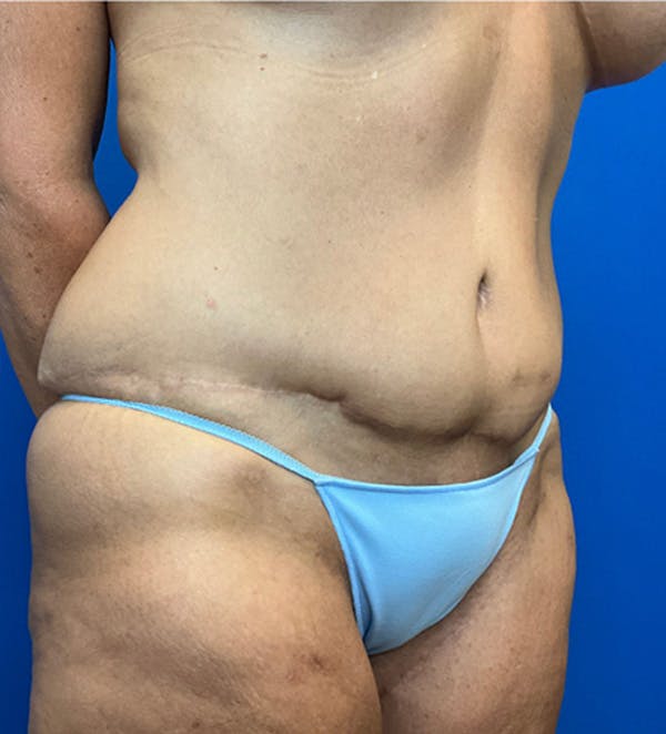 Tummy Tuck (Abdominoplasty) Before & After Gallery - Patient 149405760 - Image 4