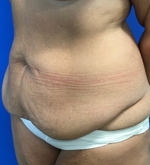 Tummy Tuck (Abdominoplasty) Before & After Gallery - Patient 149405760 - Image 5