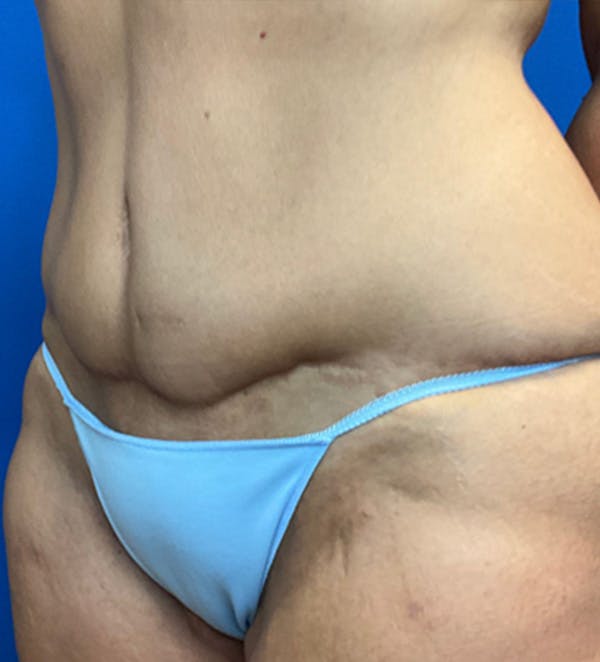 Tummy Tuck (Abdominoplasty) Before & After Gallery - Patient 149405760 - Image 6