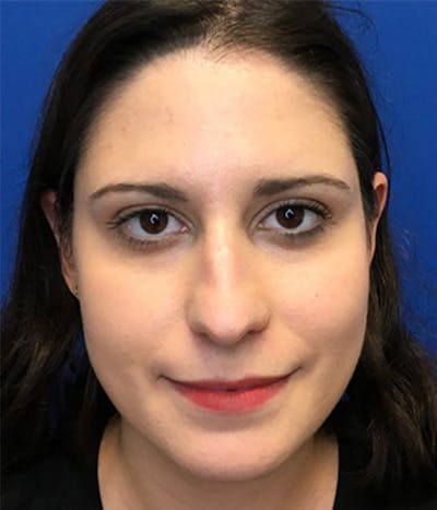 Rhinoplasty Before & After Gallery - Patient 150904933 - Image 1