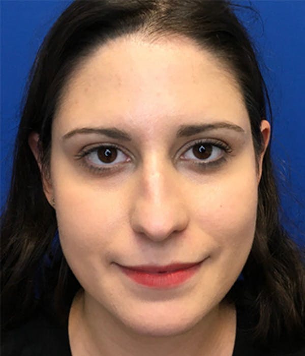 Rhinoplasty Before & After Gallery - Patient 150904933 - Image 1