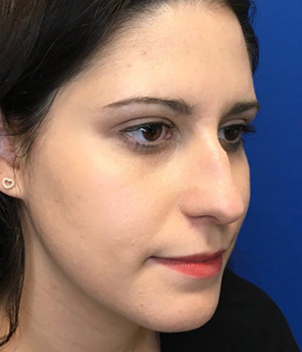 Rhinoplasty Before & After Gallery - Patient 150904933 - Image 3