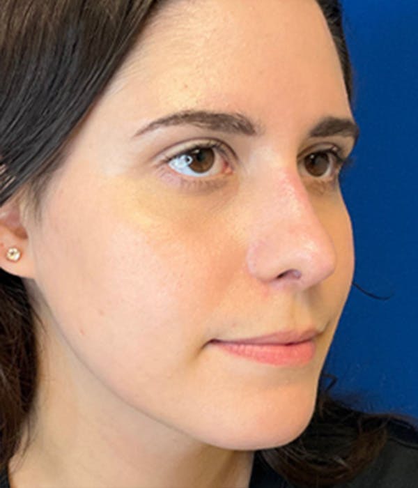 Rhinoplasty Before & After Gallery - Patient 150904933 - Image 4