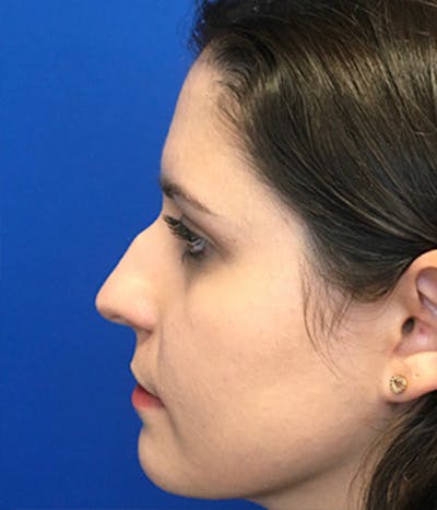 Rhinoplasty Before & After Gallery - Patient 150904933 - Image 1
