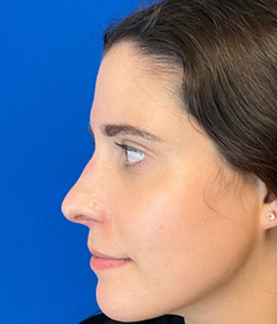 Rhinoplasty Before & After Gallery - Patient 150904933 - Image 6