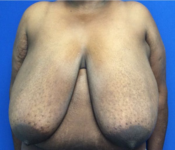 Breast Reduction Before & After Gallery - Patient 154773190 - Image 1