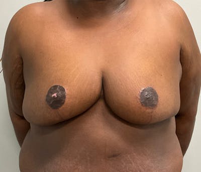 Breast Reduction Before & After Gallery - Patient 154773190 - Image 2