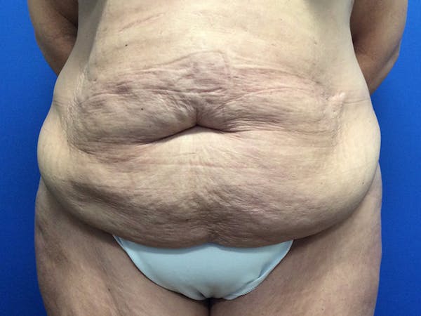 Liposuction Before & After Gallery - Patient 165534822 - Image 1