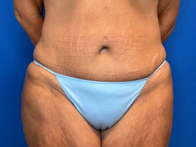 Liposuction Before & After Gallery - Patient 165534822 - Image 2