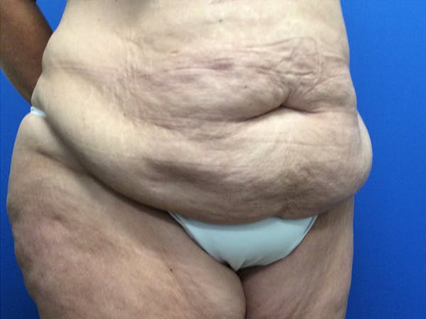 Tummy Tuck (Abdominoplasty) Before & After Gallery - Patient 165534819 - Image 3
