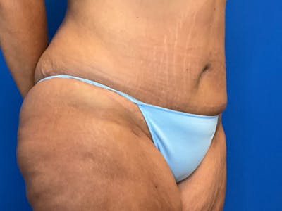 Post Bariatric Before & After Gallery - Patient 165534820 - Image 4