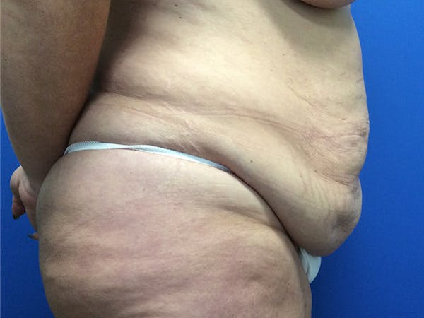 Post Bariatric Before & After Gallery - Patient 165534820 - Image 5