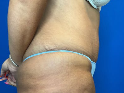 Post Bariatric Before & After Gallery - Patient 165534820 - Image 6
