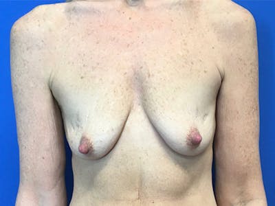 Mastopexy Before & After Gallery - Patient 165535717 - Image 1