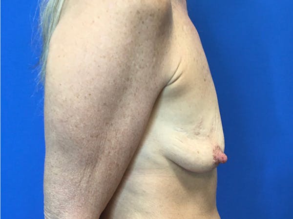 Mastopexy Before & After Gallery - Patient 165535717 - Image 5