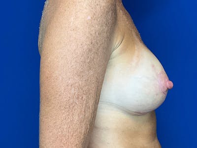 Mastopexy Before & After Gallery - Patient 165535717 - Image 6