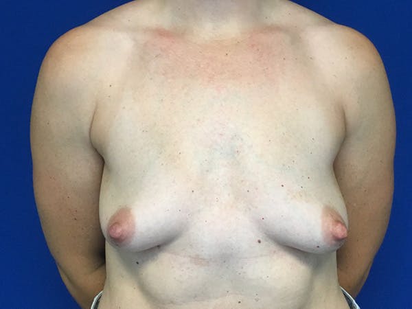 Breast Augmentation Before & After Gallery - Patient 165536265 - Image 1