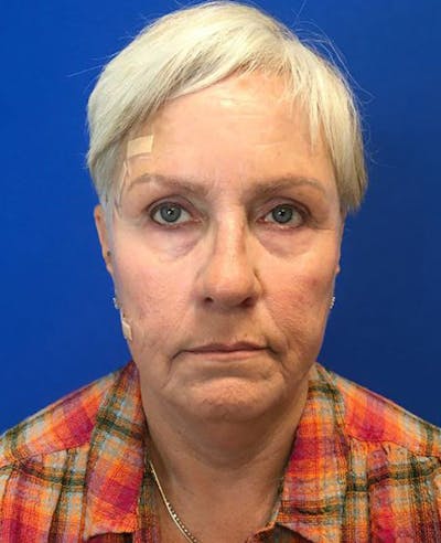 Neck Lift Before & After Gallery - Patient 174009546 - Image 1