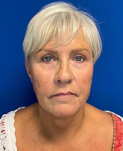 Face Lift Before & After Gallery - Patient 174009487 - Image 4