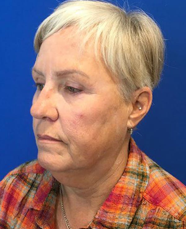 Face Lift Before & After Gallery - Patient 174009487 - Image 5