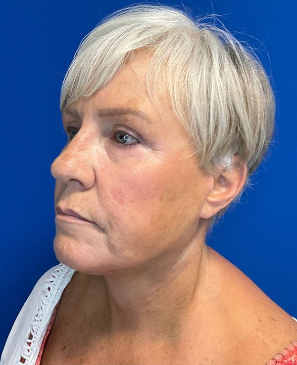 Face Lift Before & After Gallery - Patient 174009487 - Image 6