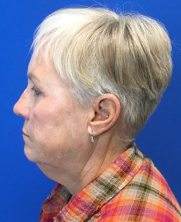 Neck Lift Before & After Gallery - Patient 174009546 - Image 5