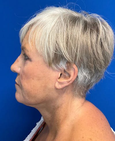 Neck Lift Before & After Gallery - Patient 174009546 - Image 6