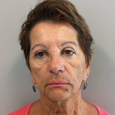 Neck Lift Before & After Gallery - Patient 181140531 - Image 1