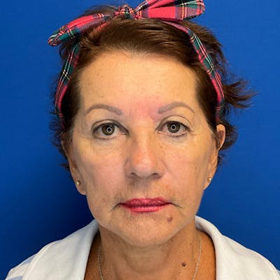Neck Lift Before & After Gallery - Patient 181140531 - Image 4