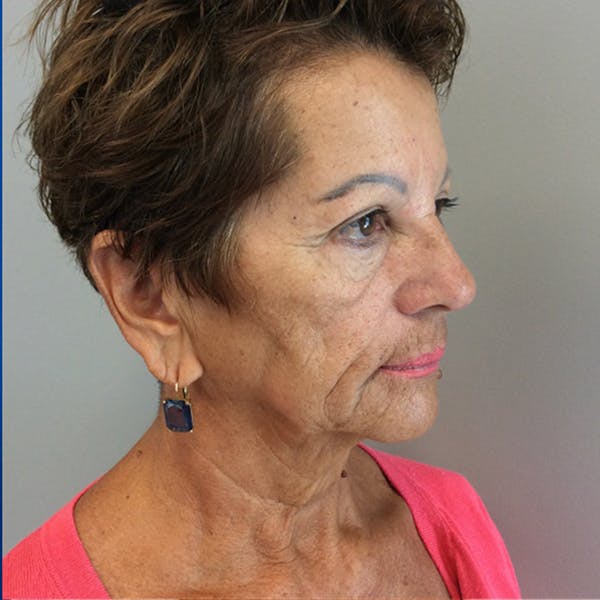 Face Lift Before & After Gallery - Patient 181140491 - Image 5