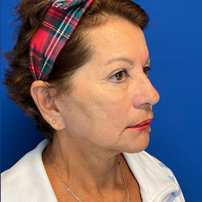 Face Lift Before & After Gallery - Patient 181140491 - Image 8