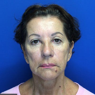 Face Lift Before & After Gallery - Patient 181140491 - Image 2