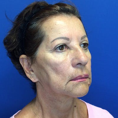 Face Lift Before & After Gallery - Patient 181140491 - Image 6