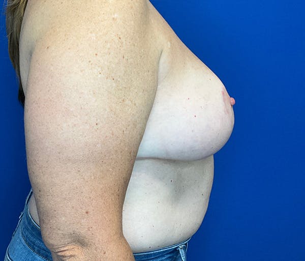 Breast Reduction Before & After Gallery - Patient 181142558 - Image 4