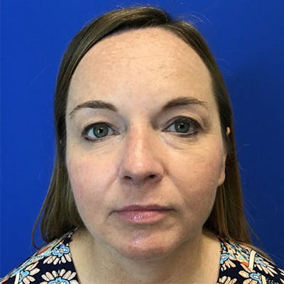 Face Lift Before & After Gallery - Patient 184322214 - Image 1