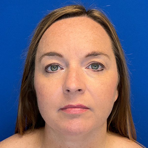 Facelift in Richmond Before & After Photos