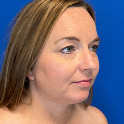 Face Lift Before & After Gallery - Patient 184322214 - Image 4