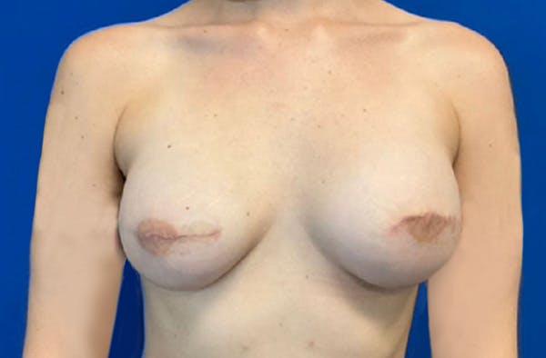 Breast Implant Reconstruction Before & After Gallery - Patient 185278678 - Image 2